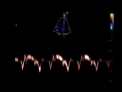 Сердце, режим тканевого спектрального допплера / РуСкан 50